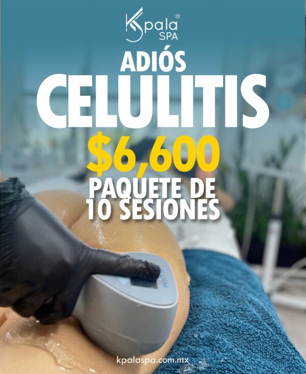 Celulitis