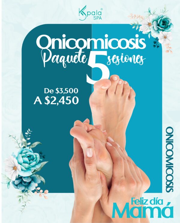 Onicomicosis