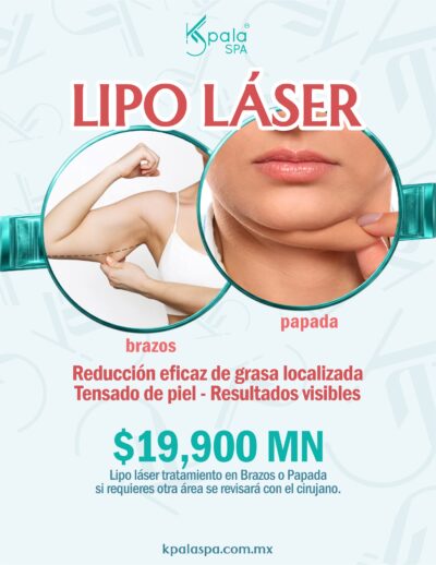 lipo laser Lipo sin cirugía