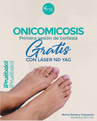 onicomicosis laser ND YAG